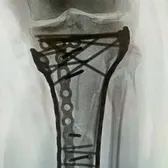 Radiografia lui Lindsey Vonn!    FOTO.  Schioarea americană, operată a 5-a oară:   „Sunt bionică acum”