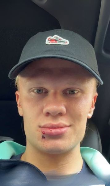 Haaland, accident straniu     Ce a pățit atacantul norvegian  în cantonamentul naționalei