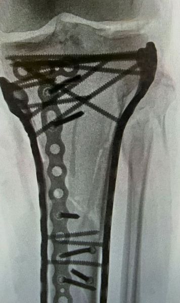 Radiografia lui Lindsey Vonn!    FOTO.  Schioarea americană, operată a 5-a oară:   „Sunt bionică acum”