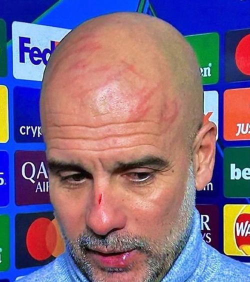 Guardiola s-a zgâriat pe față  Antrenorul lui City, după șocul cu Feyenoord din Champions League: „ Am vrut să mă rănesc ”