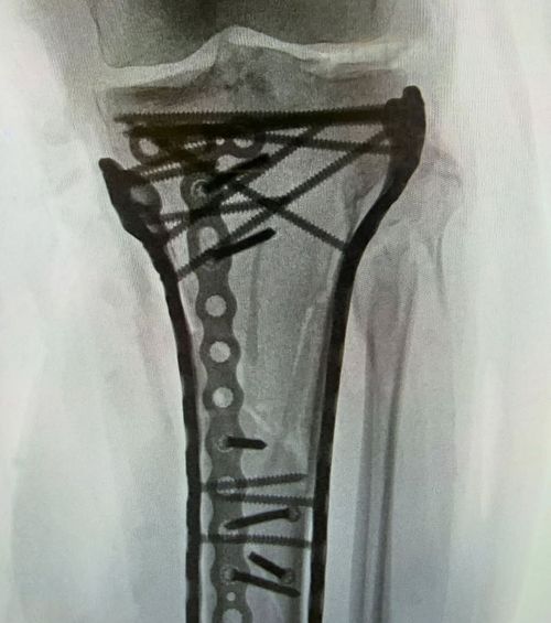 Radiografia lui Lindsey Vonn!    FOTO.  Schioarea americană, operată a 5-a oară:   „Sunt bionică acum”