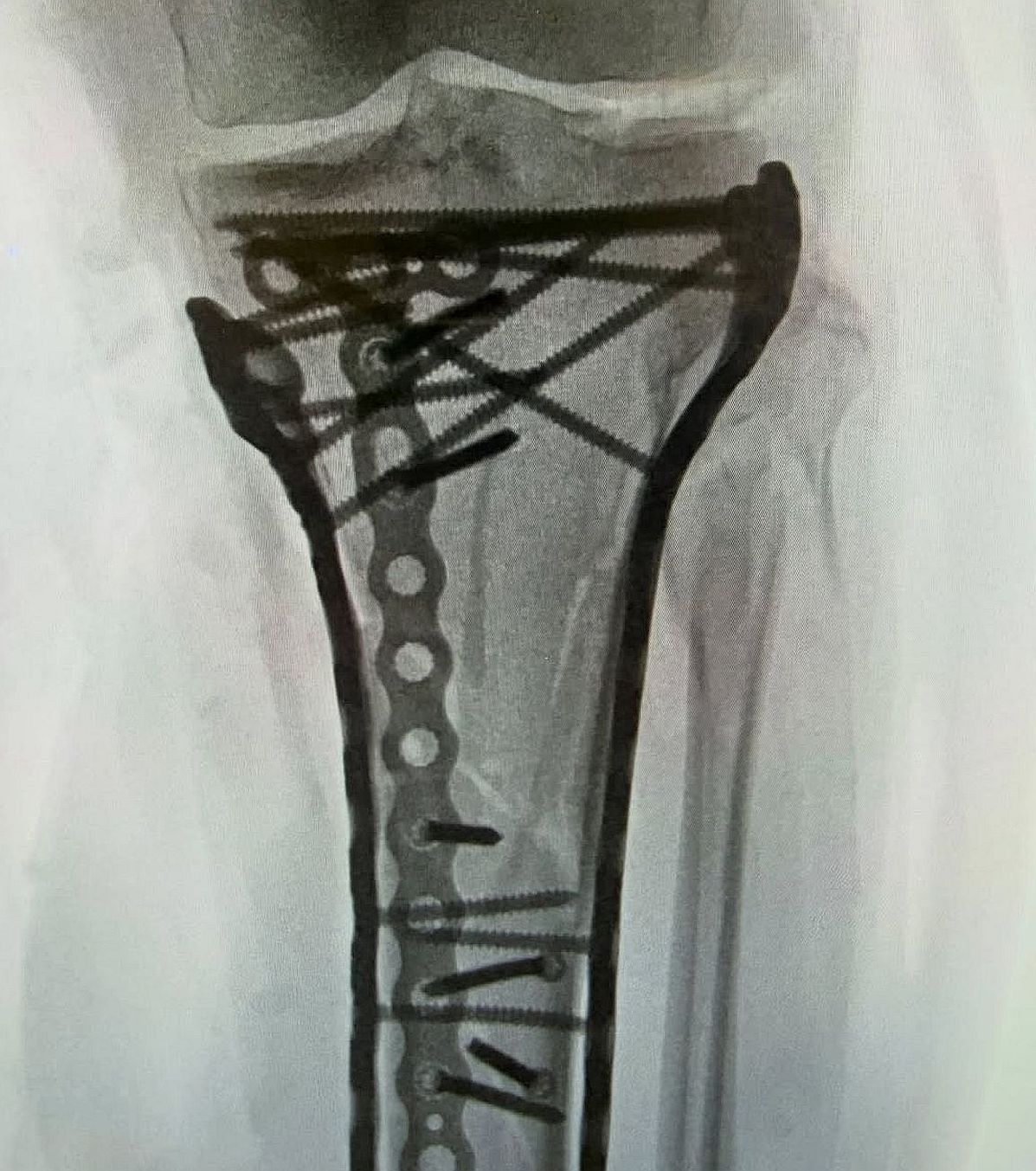 Radiografia lui Lindsey Vonn! FOTO. Schioarea americană, operată a 5-a oară: „Sunt bionică acum”